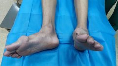 得了痛风和痛风石,怎么阻止关节破坏和关节变形?