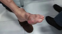 痛风常见8个误区,是不是你会做的事?