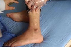 痛风犯了能忍则忍,实在忍不了再吃止痛药?