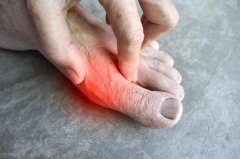 做好10个饮食原则,远离痛风减少烦恼